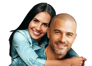 Couple effectuant de la Tricopigmentation, Micropigmentation Capillaire à Nîmes
