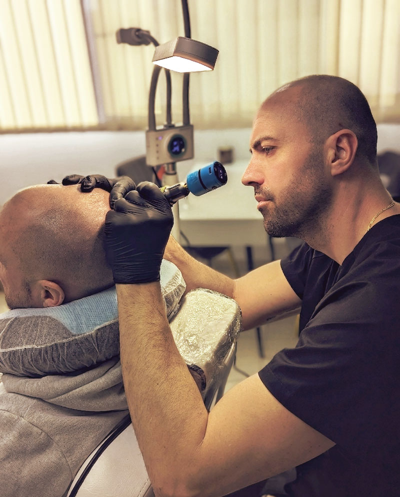 Séance de tricopigmentation avec Matthieu de chez Nemoderme - praticien en Micropigmentation capillaire à Nîmes